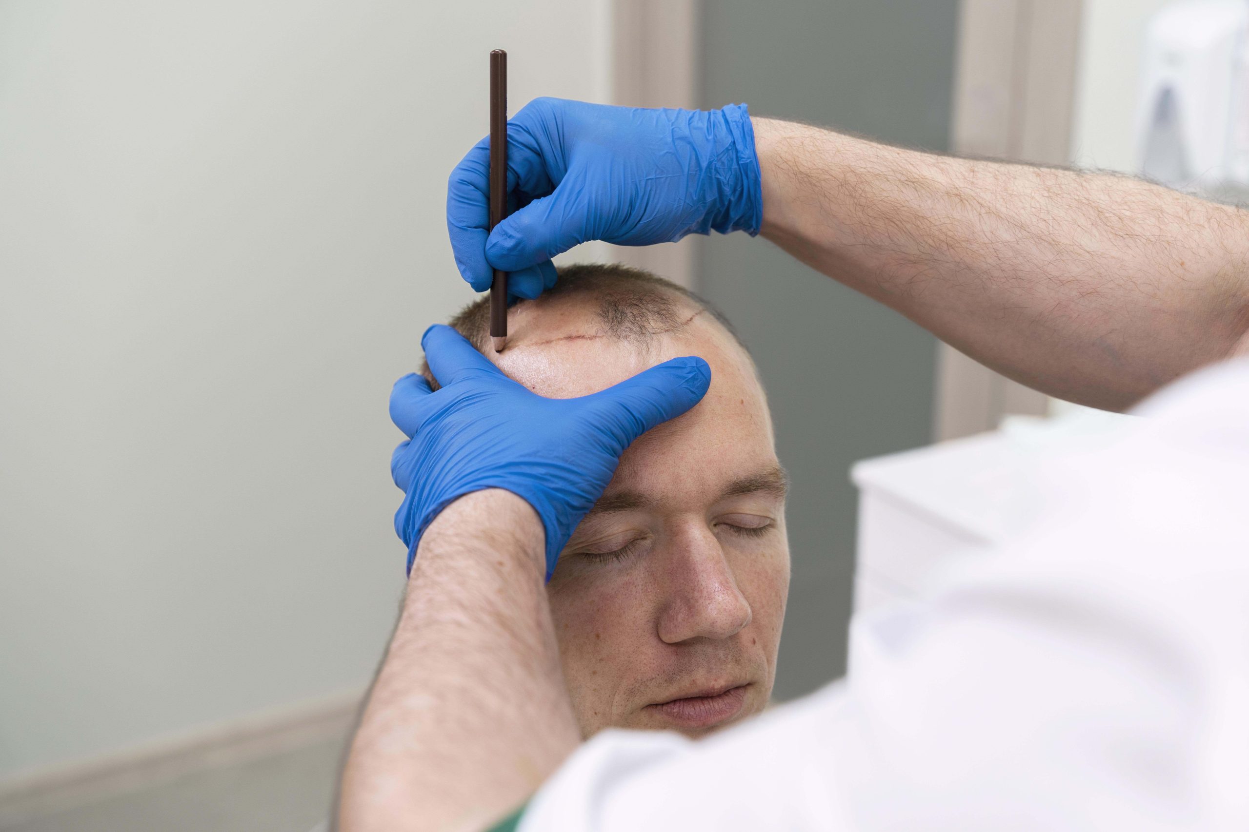 Which Hospitals do Hair Transplantation in Istanbul 8 What is the Best Hair Transplant Clinic in Istanbul scaled