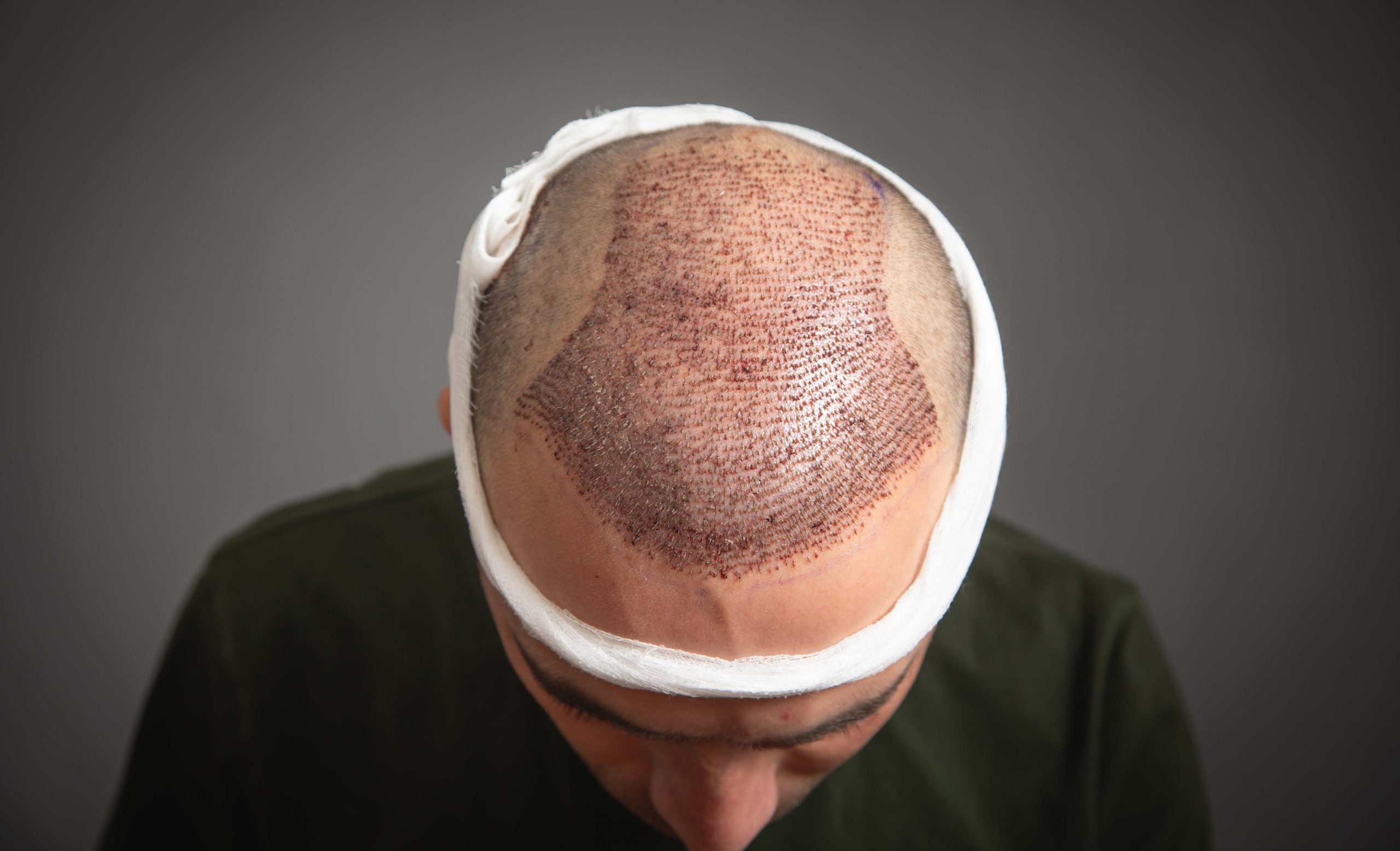Which Hospitals do Hair Transplantation in Istanbul 1 Why Istanbul for Hair Transplantation scaled