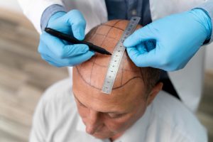 Top 10 best hair transplant centers in Istanbul